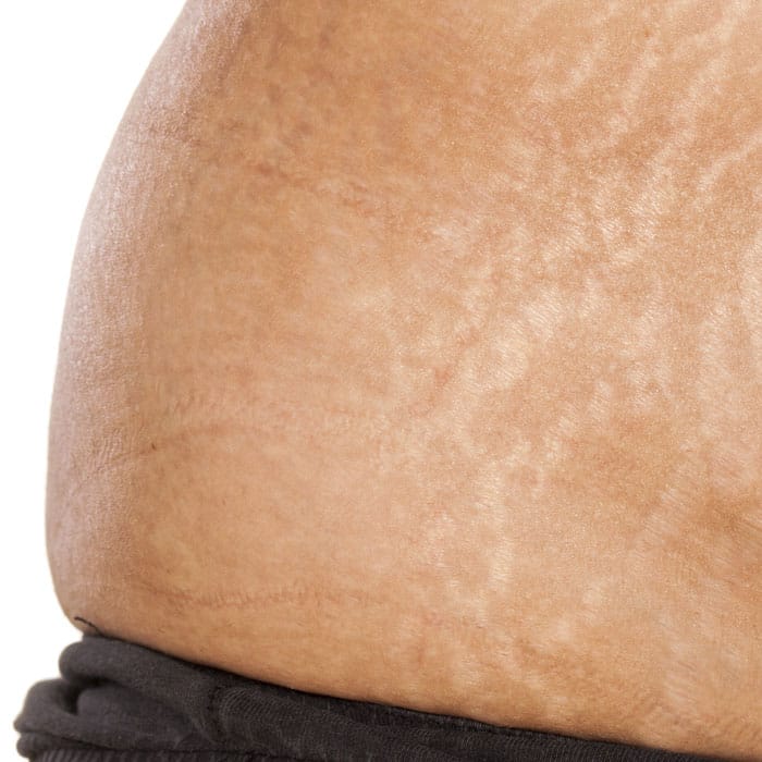 What Are Stretch Marks? - Copperstate OB/GYN