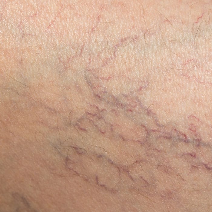 Spider & Thread Veins (Telangiectasia) in Bexhill and Canterbury